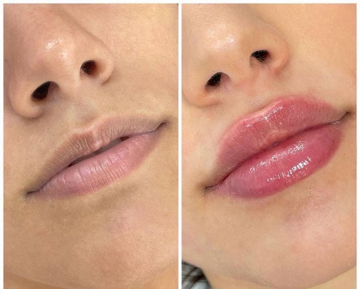 Lippen: Permanent Make-up